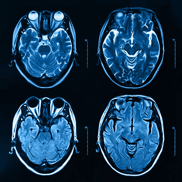 4 brain MRI Scans