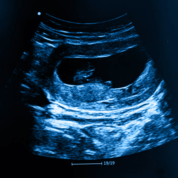 ultrasound of unborn child