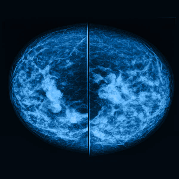 mammogram results