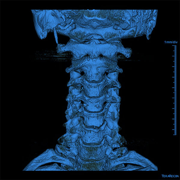 CT Scan